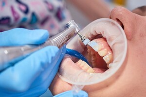 歯科医院の歯のクリーニング専用の機械で歯を磨かれている様子