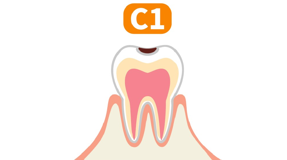 歯の表層のエナメル質に限局した虫歯（C1）のイラスト