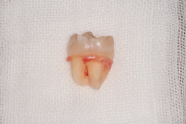 抜歯後の歯の写真