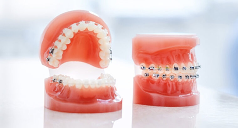 セラミック治療と歯科矯正の違いは？