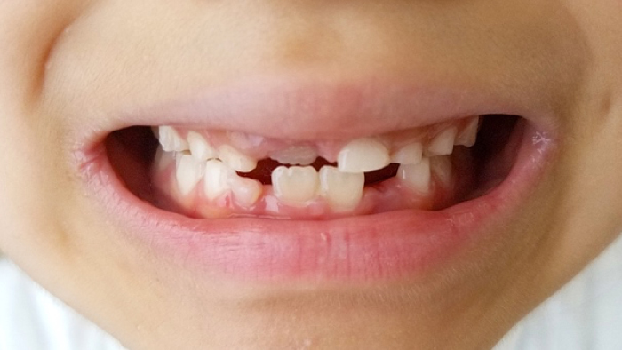 小児の歯列矯正治療の種類と開始時期、費用について