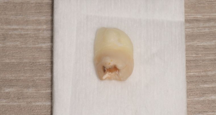抜歯後の歯の写真